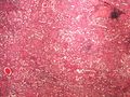 Amyloidosis kidney amyloidoza ledviny HE 4x.jpg