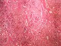 Amyloidosis liver amyloidoza jater HE 4x.jpg